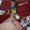 Criança é atacada por cachorro Pitbull na zona norte de Santo Ângelo