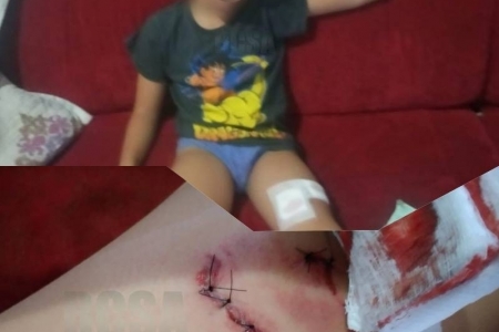 Criança é atacada por cachorro Pitbull na zona norte de Santo Ângelo