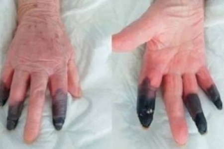 Na Itália, paciente sofre rara reação ao coronavírus e tem três dedos amputados