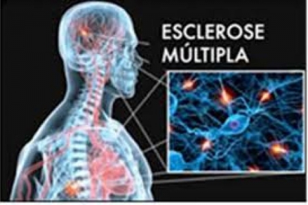 Sintomas da esclerose múltipla podem passar despercebidos e dificultar o diagnóstico