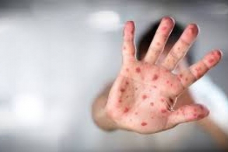 Casos de sarampo na Europa aumentam 400% em um ano, diz OMS